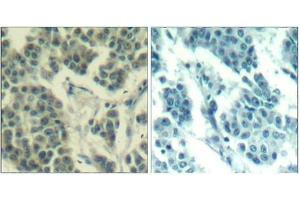 Immunohistochemical analysis of paraffin-embedded human breast carcinoma tissue using Her3/ErbB3(Phospho-Tyr1328) Antibody(left) or the same antibody preincubated with blocking peptide(right). (ERBB3 anticorps  (pTyr1328))