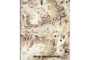 Formalin-fixed and paraffin-embedded human lung carcinoma tissue reacted with SOX2 antibody (N-term) (ABIN388797 and ABIN2839124) , which was peroxidase-conjugated to the secondary antibody, followed by DAB staining. (SOX2 anticorps  (N-Term))