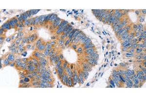 Immunohistochemistry of paraffin-embedded Human colon cancer tissue using MC1R Polyclonal Antibody at dilution 1:100 (MC1 Receptor anticorps)