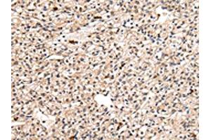 The image on the left is immunohistochemistry of paraffin-embedded Human prostate cancer tissue using ABIN7127989(PPIL1 Antibody) at dilution 1/30, on the right is treated with fusion protein. (PPIL1 anticorps)