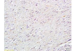 Formalin-fixed and paraffin: human cervical carcinoma labeled with Anti-RB1CC1 Polyclonal Antibody , Unconjugated at 1:200 followed by conjugation to the secondary antibody and DAB staining