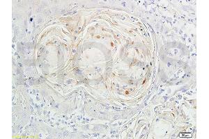 Formalin-fixed and paraffin embedded human oral squamous cell carcinoma labeled with Anti-Phospho-FoxO3a (Ser318/321) Polyclonal Antibody, Unconjugated (ABIN684688) at 1:200 followed by conjugation to the secondary antibody and DAB staining