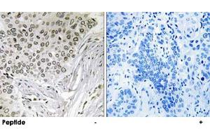 Immunohistochemistry analysis of paraffin-embedded human lung carcinoma tissue, using EFTUD2 polyclonal antibody . (EFTUD2 anticorps)