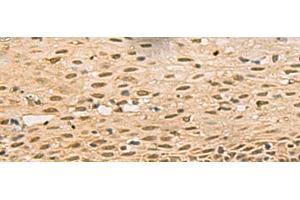 Immunohistochemistry of paraffin-embedded Human cervical cancer tissue using FOXH1 Polyclonal Antibody at dilution of 1:40(x200) (FOXH1 anticorps)
