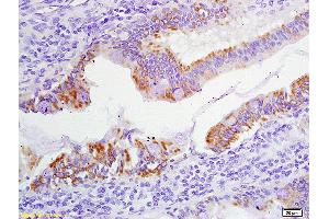 Formalin-fixed and paraffin embedded human colon carcinoma labeled with Anti-Phospho-FHIT (Tyr114) Polyclonal Antibody, Unconjugated (ABIN684808) at 1:200 followed by conjugation to the secondary antibody and DAB staining (FHIT anticorps  (pTyr114))