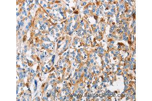 Immunohistochemistry of Human thyroid cancer using CTSL Polyclonal Antibody at dilution of 1:50 (Cathepsin L anticorps)