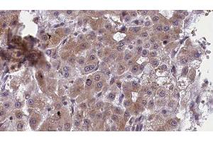 ABIN6277419 at 1/100 staining Human liver cancer tissue by IHC-P.