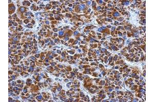 IHC-P Image Immunohistochemical analysis of paraffin-embedded human hepatoma, using DLD, antibody at 1:500 dilution. (DLD anticorps)