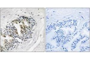 Immunohistochemistry analysis of paraffin-embedded human prostate carcinoma tissue, using RPLP2 Antibody.