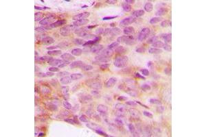 Immunohistochemical analysis of NDUFV3 staining in human breast cancer formalin fixed paraffin embedded tissue section. (NDUFV3 anticorps  (Center))