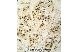 Formalin-fixed and paraffin-embedded human breast carcinoma tissue reacted with CDK1 Antibody (T14) (ABIN391744 and ABIN2841621) , which was peroxidase-conjugated to the secondary antibody, followed by DAB staining. (CDK1 anticorps  (AA 1-30))