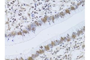 Immunohistochemistry of paraffin-embedded human gastric cancer using LMNB2 Antibody (ABIN5973877) at dilution of 1/100 (40x lens). (Lamin B2 anticorps)