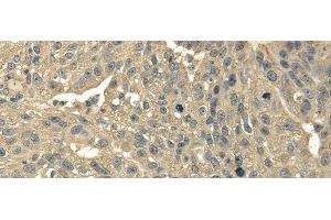 Immunohistochemistry of paraffin-embedded Human breast cancer using TRIB2 Polyclonal Antibody at dilution of 1/30 (TRIB2 anticorps)