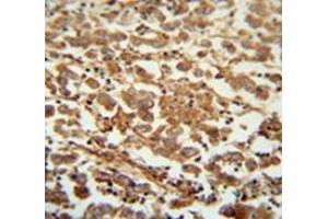 Immunohistochemistry analysis inhuman testis carcinoma (Formalin-fixed, Paraffin-embedded) using Speriolin / SPATC1 Antibody  (N-term), followed by peroxidase conjugation of the secondary antibody and DAB staining. (SPATC1 anticorps  (N-Term))