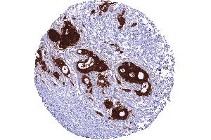 Gastric adenocarcinoma with intense GPX2 staining of all tumor cells