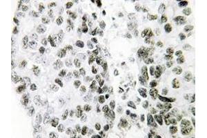 Immunohistochemistry analysis of SNAI1 antibody in paraffin-embedded Human lung carcinoma tissue. (SNAIL anticorps)