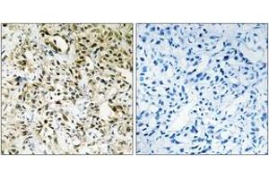 Immunohistochemistry analysis of paraffin-embedded human liver carcinoma tissue, using PPHLN Antibody. (PPHLN1 anticorps  (AA 71-120))