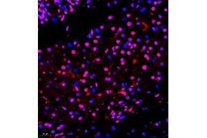 Immunofluorescence of paraffin embedded human liver cancer using smad62024 (ABIN7075629) at dilution of 1:1000 (400x lens)