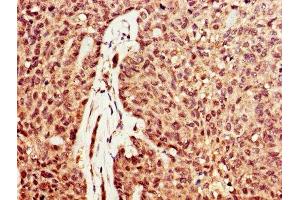 IHC image of ABIN7149726 diluted at 1:600 and staining in paraffin-embedded human ovarian cancer performed on a Leica BondTM system.