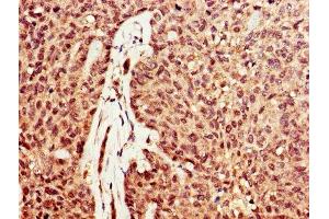IHC image of ABIN7149726 diluted at 1:600 and staining in paraffin-embedded human ovarian cancer performed on a Leica BondTM system. (DNASE1 anticorps  (AA 78-231))