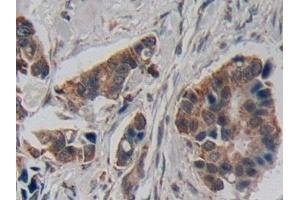 Detection of CRF in Human Breast cancer Tissue using Polyclonal Antibody to Corticotropin Releasing Factor (CRF)