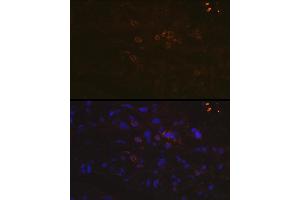 Immunofluorescence analysis of human breast cancer using PD-L1/CD274 Rabbit pAb (ABIN6129976, ABIN6138153, ABIN6138154 and ABIN6215142) at dilution of 1:100 (40x lens). (PD-L1 anticorps  (AA 19-238))