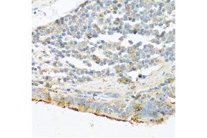 Immunohistochemistry of paraffin-embedded human lung cancer using PRSS1 antibody at dilution of 1:100 (40x lens). (PRSS1 anticorps)