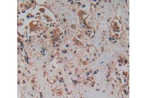 IHC-P analysis of breast cancer tissue, with DAB staining.