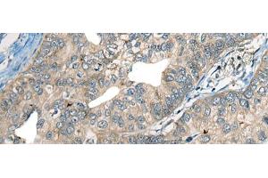 Immunohistochemistry of paraffin-embedded Human gastric cancer tissue using CDADC1 Polyclonal Antibody at dilution of 1:60(x200) (CDADC1 anticorps)