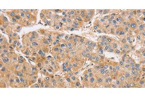 Immunohistochemistry of paraffin-embedded Human liver cancer tissue using ARMCX1 Polyclonal Antibody at dilution 1:40 (ARMCX1 anticorps)