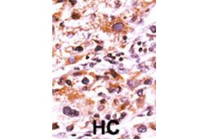 Immunohistochemistry (IHC) image for anti-FGFR (pTyr766) antibody (ABIN3001757) (FGFR (pTyr766) anticorps)