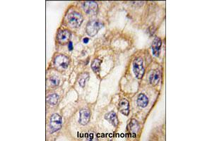 Formalin-fixed and paraffin-embedded human lung carcinoma tissue reacted with CD8A polyclonal antibody , which was peroxidase-conjugated to the secondary antibody, followed by DAB staining.