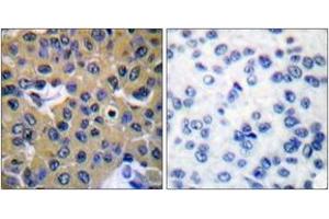 Immunohistochemistry analysis of paraffin-embedded human breast carcinoma, using SHP-2 (Phospho-Tyr542) Antibody. (PTPN11 anticorps  (pTyr542))