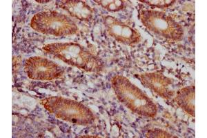 IHC image of ABIN7127403 diluted at 1:100 and staining in paraffin-embedded human colon cancer performed on a Leica BondTM system. (Recombinant CD46 anticorps)