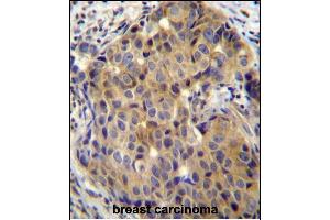 ST14 Antibody (C-term) (ABIN652185 and ABIN2840675) immunohistochemistry analysis in formalin fixed and paraffin embedded human breast carcinoma followed by peroxidase conjugation of the secondary antibody and DAB staining. (ST14 anticorps  (C-Term))
