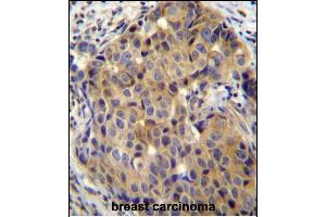 ST14 Antibody (C-term) (ABIN652185 and ABIN2840675) immunohistochemistry analysis in formalin fixed and paraffin embedded human breast carcinoma followed by peroxidase conjugation of the secondary antibody and DAB staining. (ST14 anticorps  (C-Term))