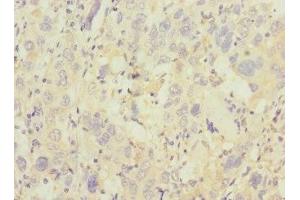 Immunohistochemistry of paraffin-embedded human liver cancer using ABIN7172186 at dilution of 1:100 (TRHDE anticorps  (AA 62-200))