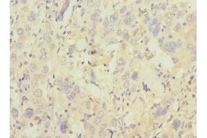Immunohistochemistry of paraffin-embedded human liver cancer using ABIN7172186 at dilution of 1:100