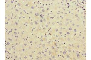 Immunohistochemistry of paraffin-embedded human liver cancer using ABIN7142967 at dilution of 1:100