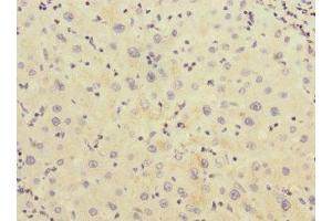 Immunohistochemistry of paraffin-embedded human liver cancer using ABIN7142967 at dilution of 1:100 (CHRNE anticorps  (AA 21-239))