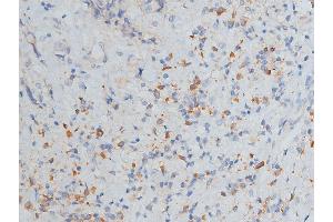 ABIN6268776 at 1/200 staining human breast cancer tissue sections by IHC-P.