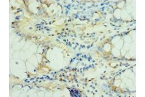 Immunohistochemistry of paraffin-embedded human colon cancer using ABIN7159382 at dilution of 1:100 (MS4A12 anticorps  (AA 1-90))