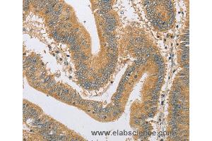 Immunohistochemistry of Human liver cancer using ARHGEF1 Polyclonal Antibody at dilution of 1:60