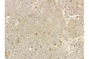 ABIN6266219 and ABIN6277379 at 1/100 staining human melanoma by IHC-P.