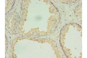 Immunohistochemistry of paraffin-embedded human prostate cancer using ABIN7150902 at dilution of 1:100 (CCDC135 anticorps  (AA 1-300))