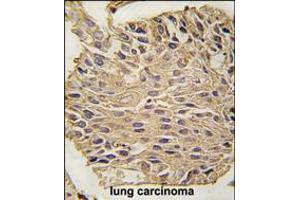 Formalin-fixed and paraffin-embedded human lung carcinoma tissue reacted with ALDOA antibody , which was peroxidase-conjugated to the secondary antibody, followed by DAB staining.