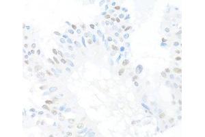Immunohistochemistry of paraffin-embedded Human mammary cancer using CREM Polyclonal Antibody at dilution of 1:100 (40x lens).