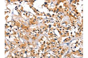 The image on the left is immunohistochemistry of paraffin-embedded Human thyroid cancer tissue using ABIN7128916(CEP97 Antibody) at dilution 1/40, on the right is treated with fusion protein. (CEP97 anticorps)