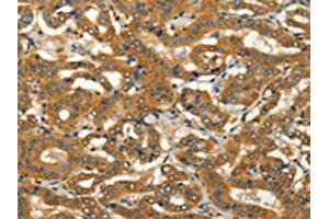 The image on the left is immunohistochemistry of paraffin-embedded Human thyroid cancer tissue using ABIN7128251(ADCY3 Antibody) at dilution 1/50, on the right is treated with fusion protein. (ADCY3 anticorps)