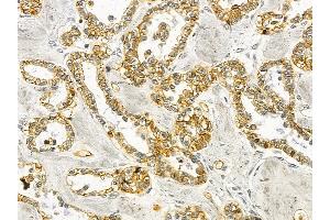 Annexin A2 Mouse Monoclonal Antibody at 1/100 staining human ovarian cancer by IHC-P. (Annexin A2 anticorps  (Internal Region))